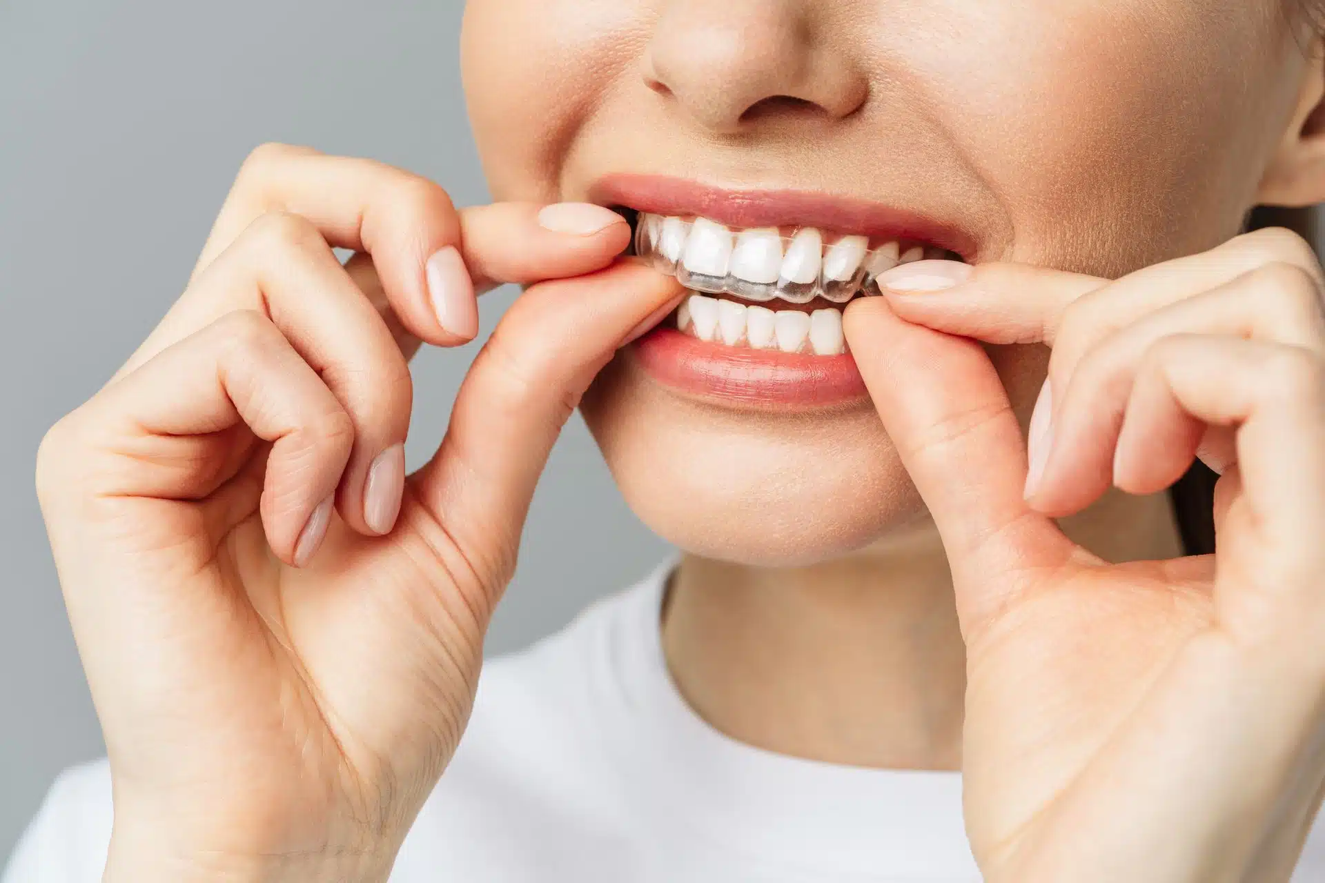 This is a thumbnail image of blog How to Care for Your Invisalign Aligners: Dos and Don’ts