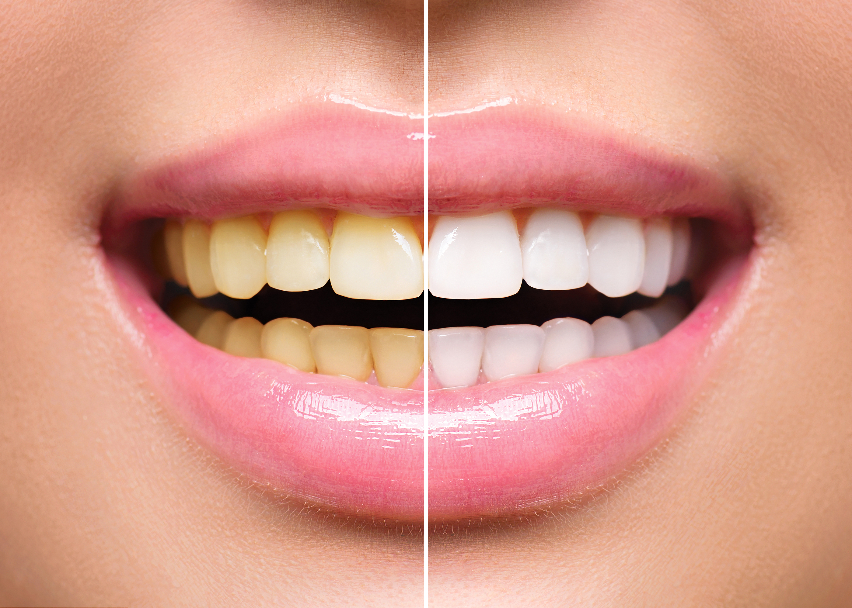 This is a thumbnail image of blog Brightening Your Smile: The Benefits of Teeth Whitening in Santa Clara, CA