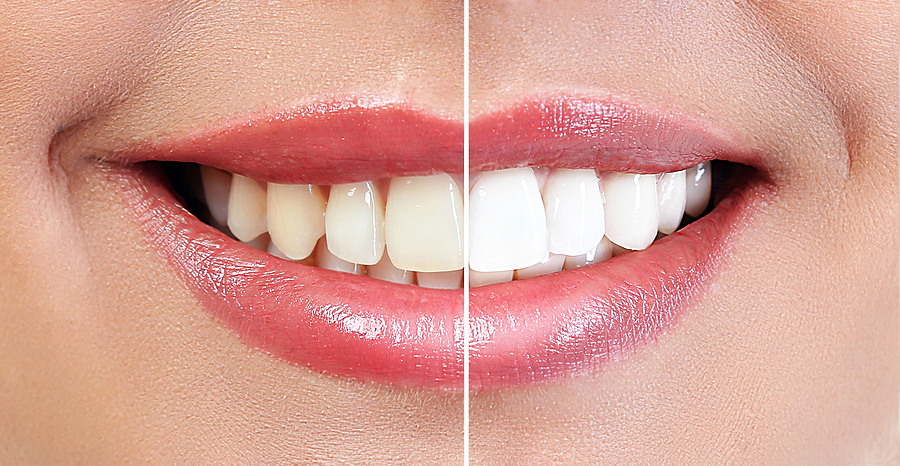 This is a thumbnail image of blog Achieve a Brighter Smile with Professional Teeth Whitening in Santa Clara, CA