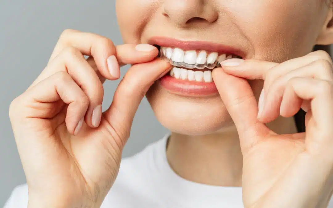 How to Care for Your Invisalign Aligners: Dos and Don’ts